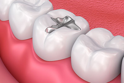 Dean Dental | Implant Dentistry, Sleep Apnea and Teeth Whitening