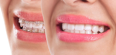 Dean Dental | Botox reg , Extractions and Dental Fillings