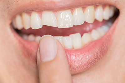 Dean Dental | Dentures, Invisalign reg  and TMJ Disorders